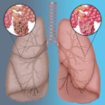 cigarro causa enfisema