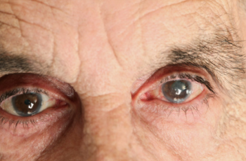 Quais os sintomas da catarata nos olhos