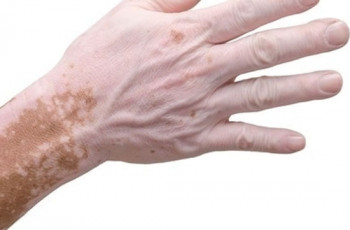 Afinal, Vitiligo é contagioso?