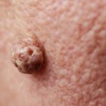 Podofilina para que serve