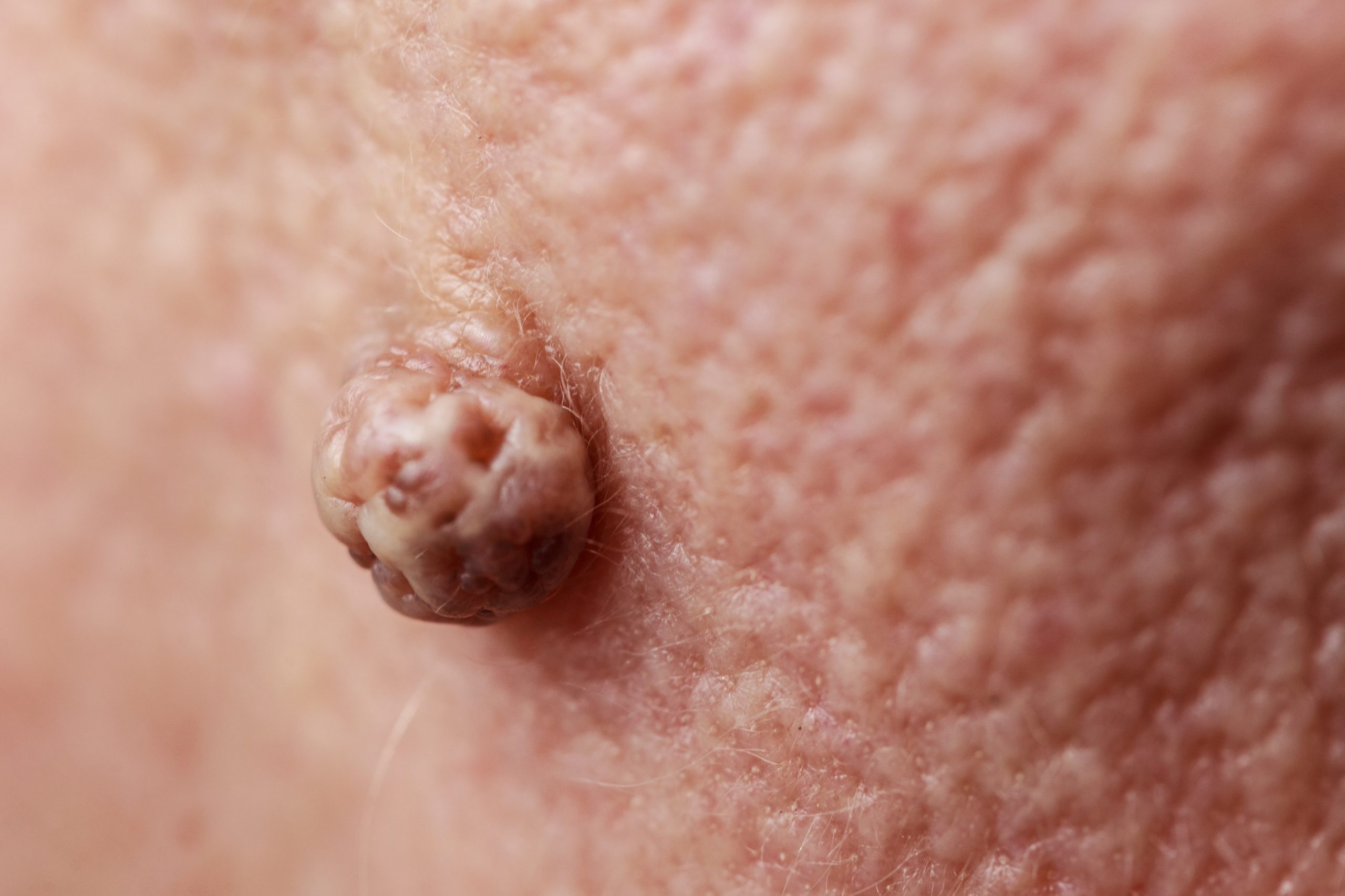 Podofilina para que serve